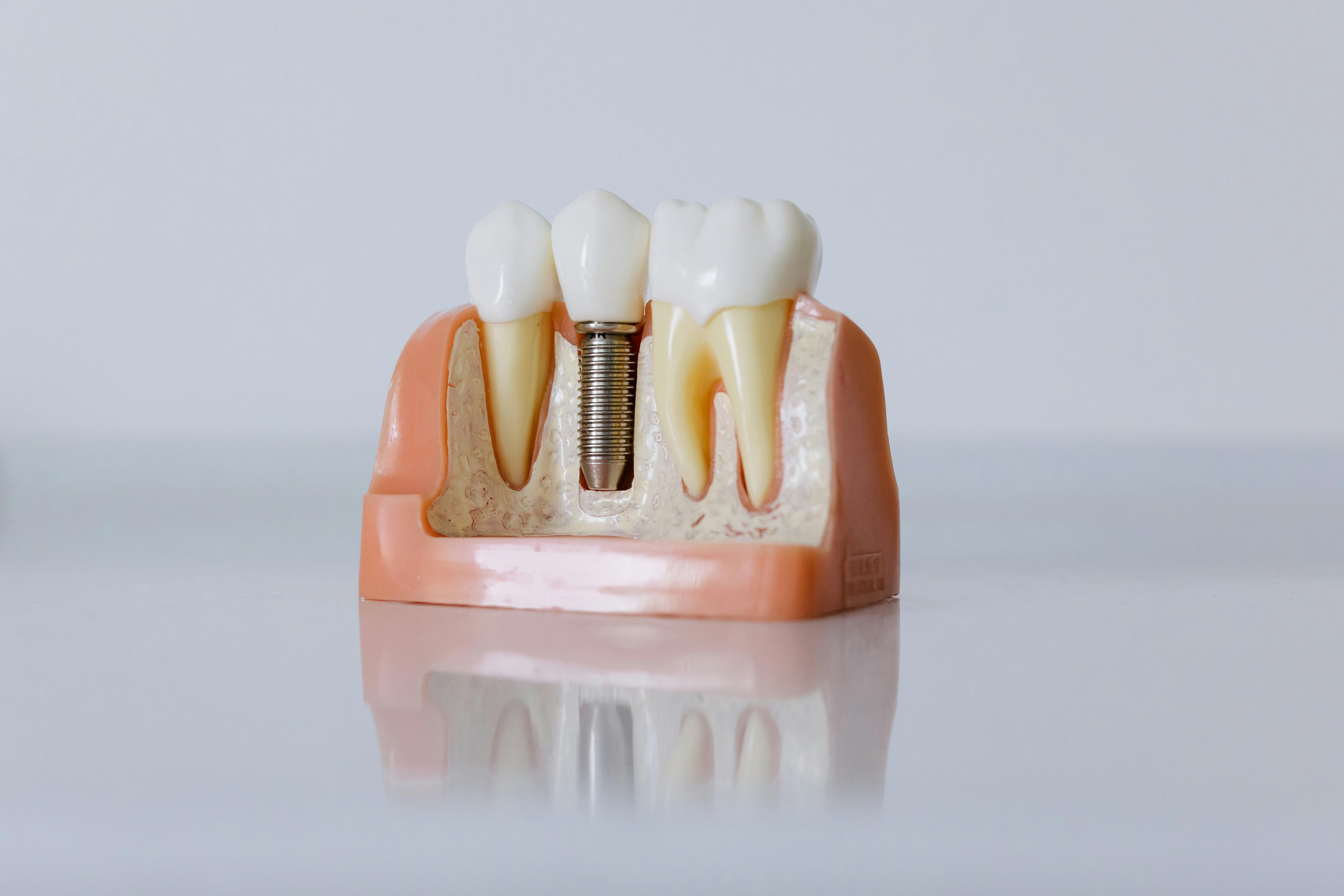 Implantaten